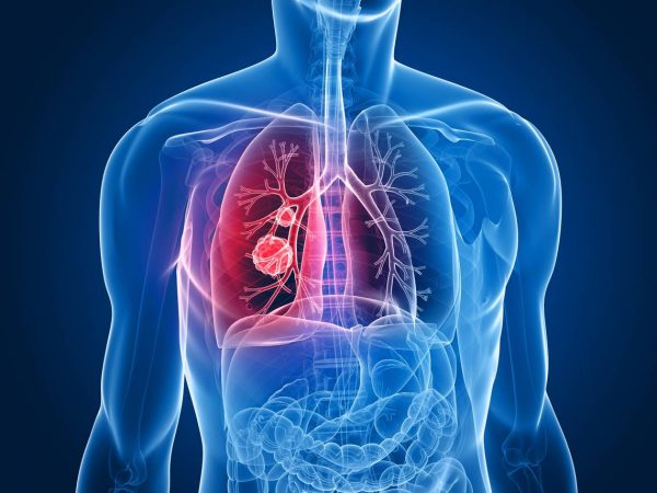Những  cách trị viêm phổi tại nhà hiệu quả và an toàn