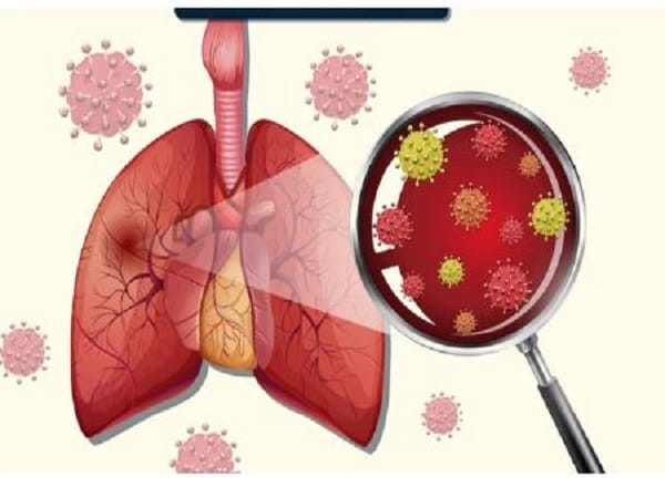 Chút thông tin về bệnh viêm phổi