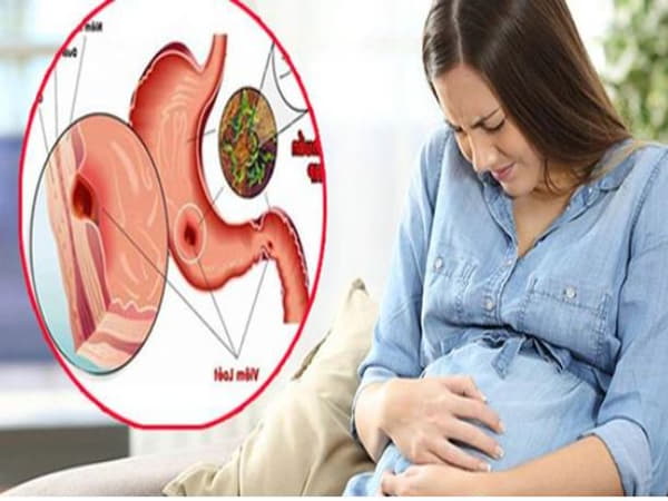 Nguyên nhân đau dạ dày khi mang thai
