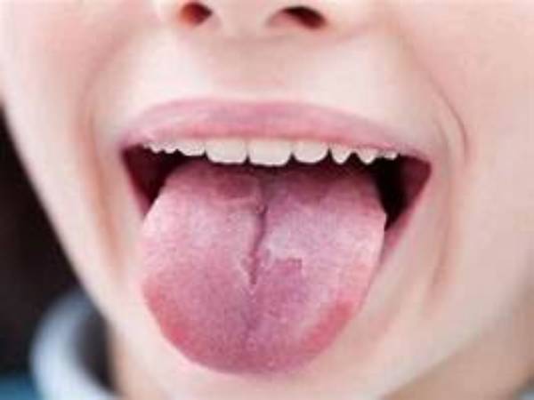 bài thuốc nam chữa viêm lưỡi